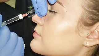 Non-Surgical Nose Job or Non-Surgical Rhinoplasty.  Before and After