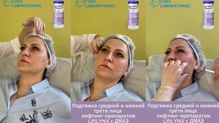 LiftLYNX Подтяжка средней и нижней трети
