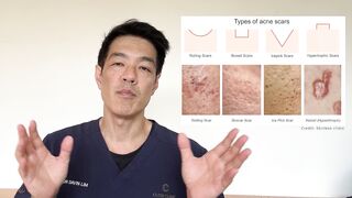 Treatments for Ice pick acne scars | Dr Davin Lim