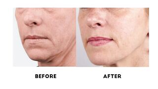 People&Skin: Bio-revitalization Treatment - Mesotherapy face
