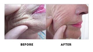 People&Skin: Bio-revitalization Treatment - Mesotherapy face