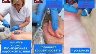 карбокситерапия