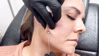 Thread Lift with Dr.Gideon Kwok│Skin Perfect Medical