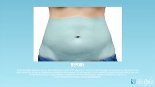 That's Cool with CoolSculpting Skin Perfect