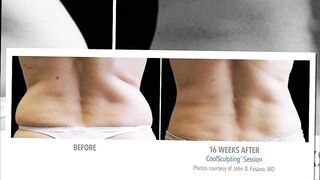 CoolSculpting Skin Perfect Rancho