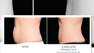 CoolSculpting Skin Perfect Rancho